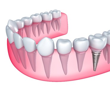 Illustration of a single dental implant in Las Vegas, NV