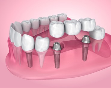 Illustration of dental bridge supported by dental implants in Las Vegas, NV