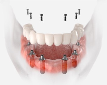 Dentures being attached to dental implants in Las Vegas, NV