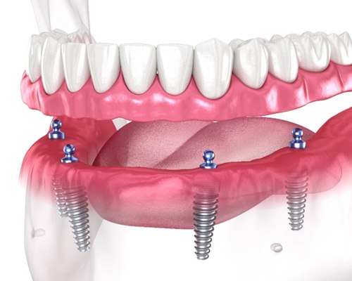 Illustration of All-on-4 dental implants in Las Vegas, NV
