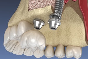 Dental implants in Las Vegas, NV placed after sinus lift