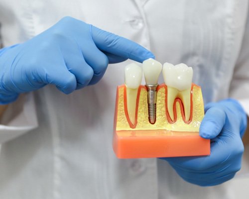 Dentist pointing to model of dental implant in Las Vegas, NV