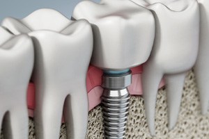 Illustration of dental implant in Las Vegas, NV in jawbone