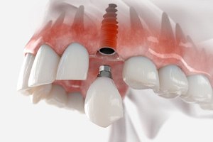 Dental implant in Las Vegas, NV receiving crown